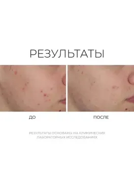 Shineless Oil-Free Moisturizer – Увлажняющий крем для проблемной кожи